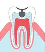 象牙質まで進んだむし歯