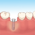 インプラント埋入