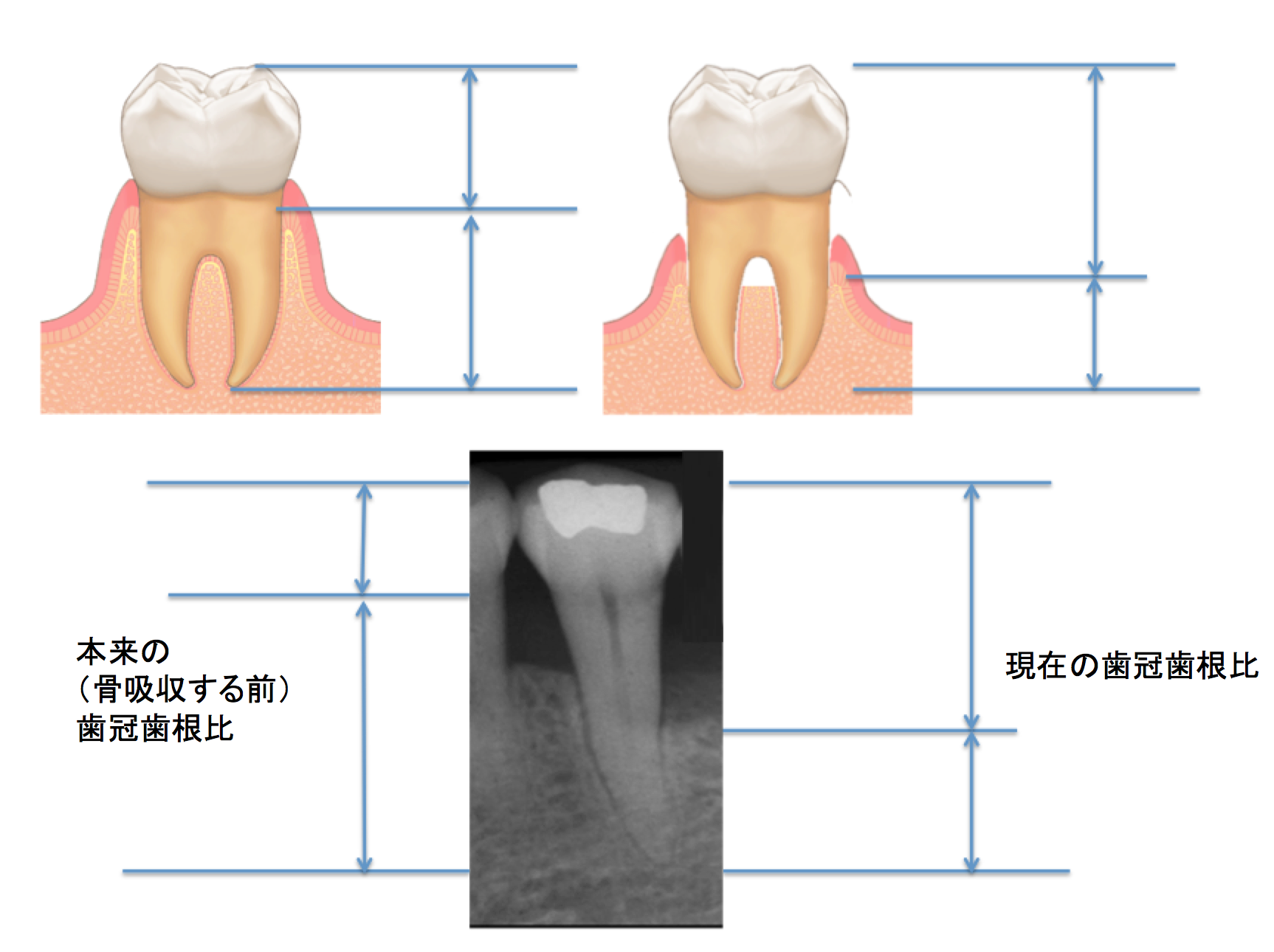 入れ歯について知ろう−その69—歯冠歯根比とは?|大阪吹田市寿町のよしなか歯科クリニック