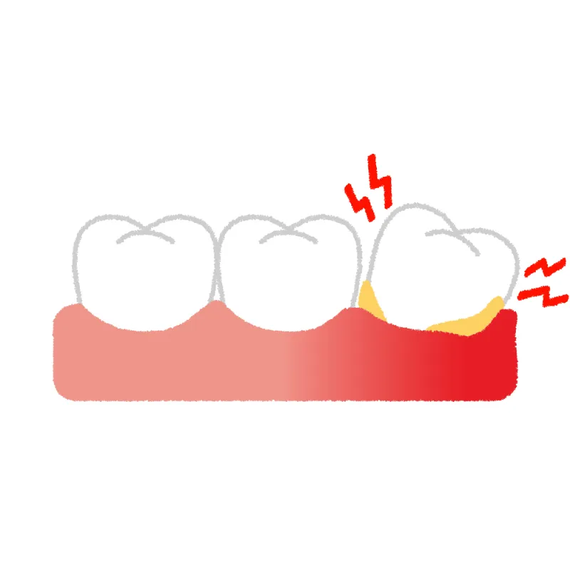 歯周病を予防。